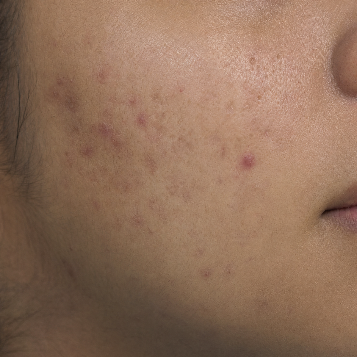 Skin Breakouts